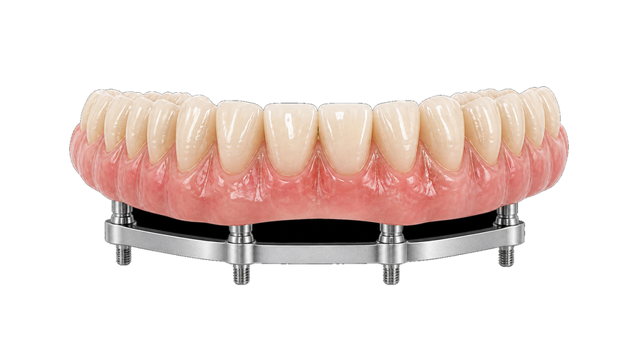 PMMA full-arch bridge shown above a titanium bar support.