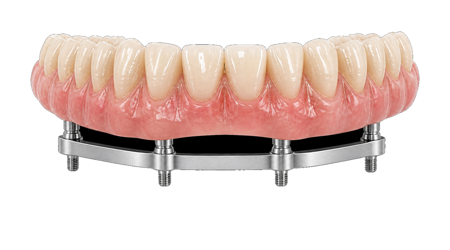 PMMA screw-retained provisional arch with titanium bar support.