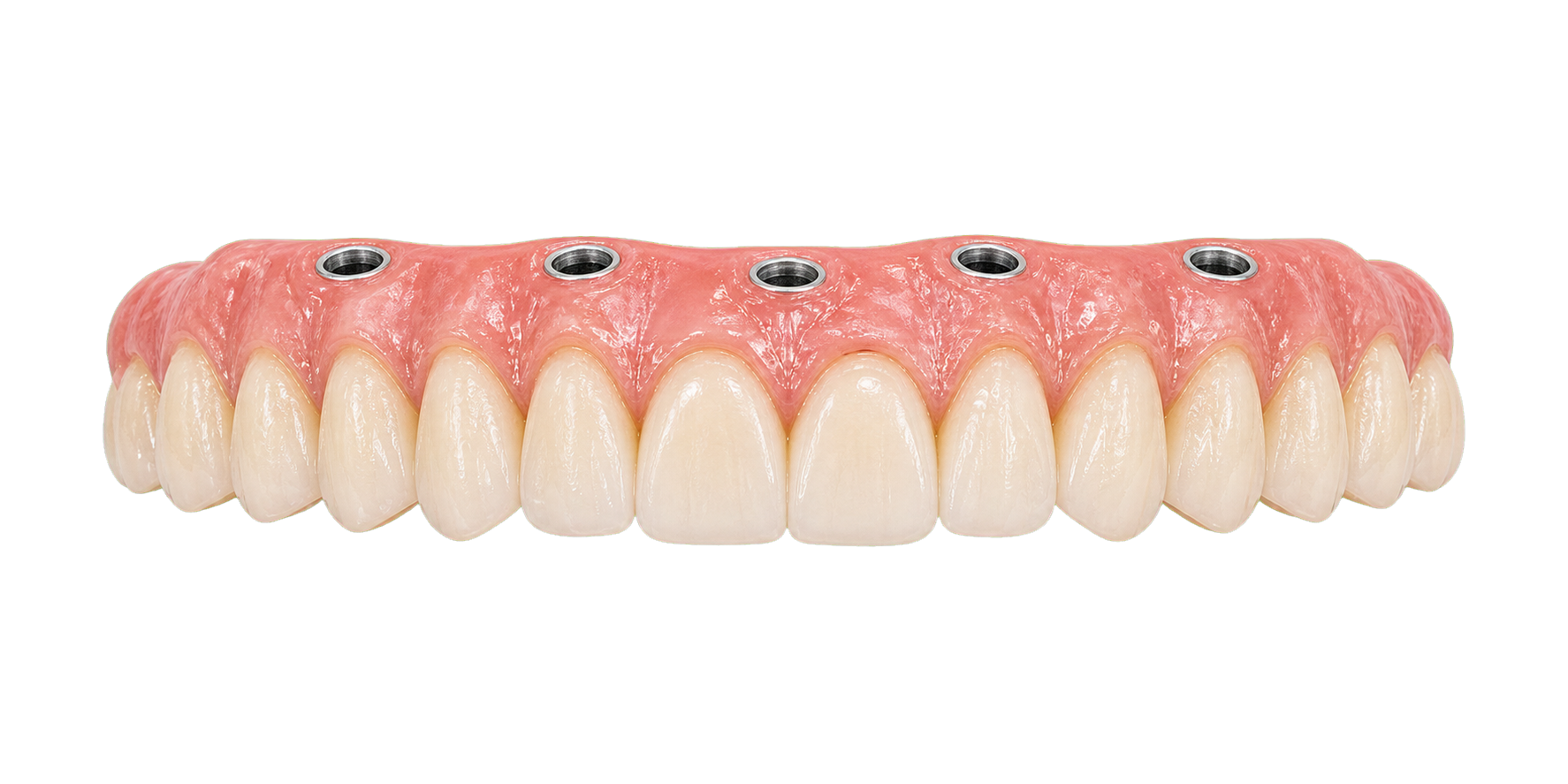 Transparent All on 5 implant-supported arch planning visual.