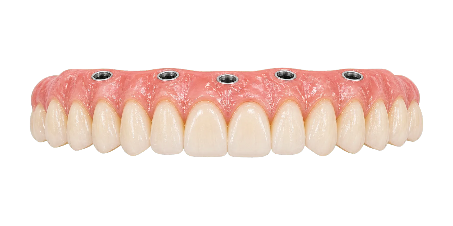 Transparent All on 5 implant-supported arch planning visual.