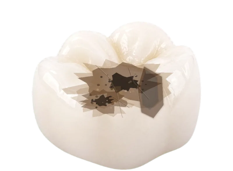 Molar with extensive missing structure and weakened walls that may require a crown.