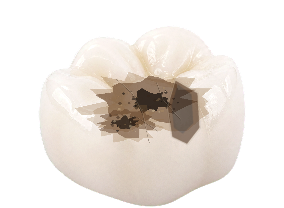 Molar with extensive missing structure and weakened walls that may require a crown.