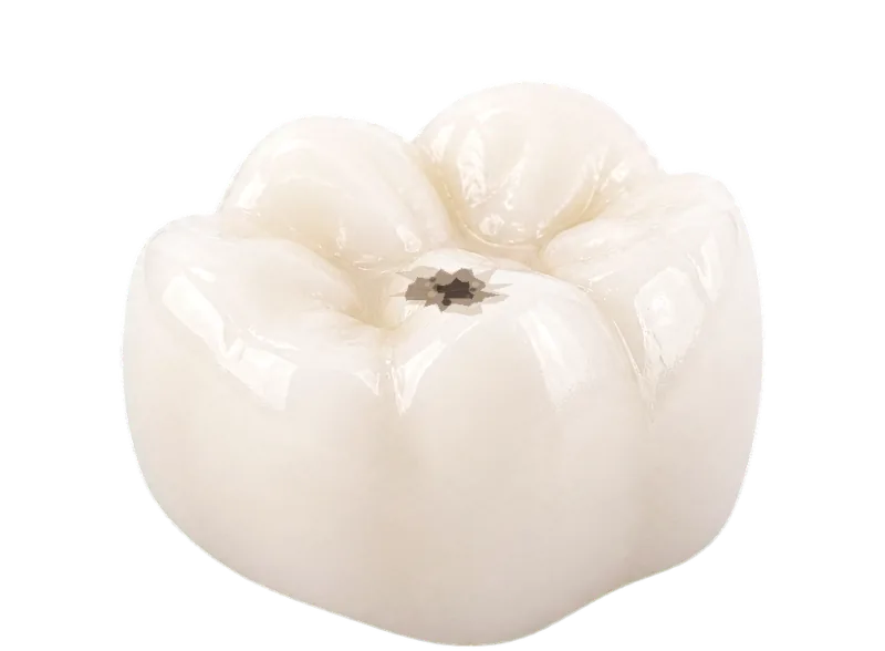 Molar with a small contained defect that may be restored with a filling.