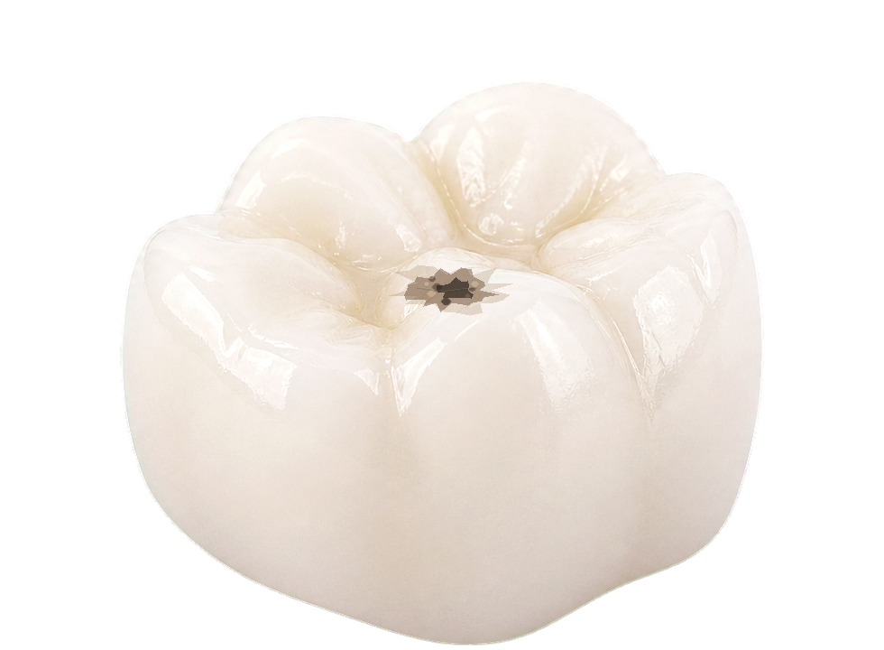 Tooth visual showing a contained filling-level repair.