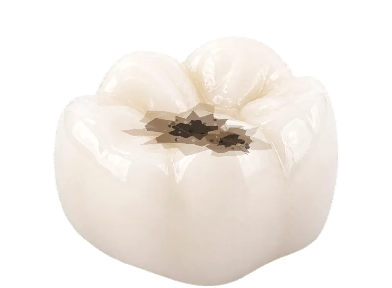Molar with broader damage where partial coverage may support one weakened cusp.