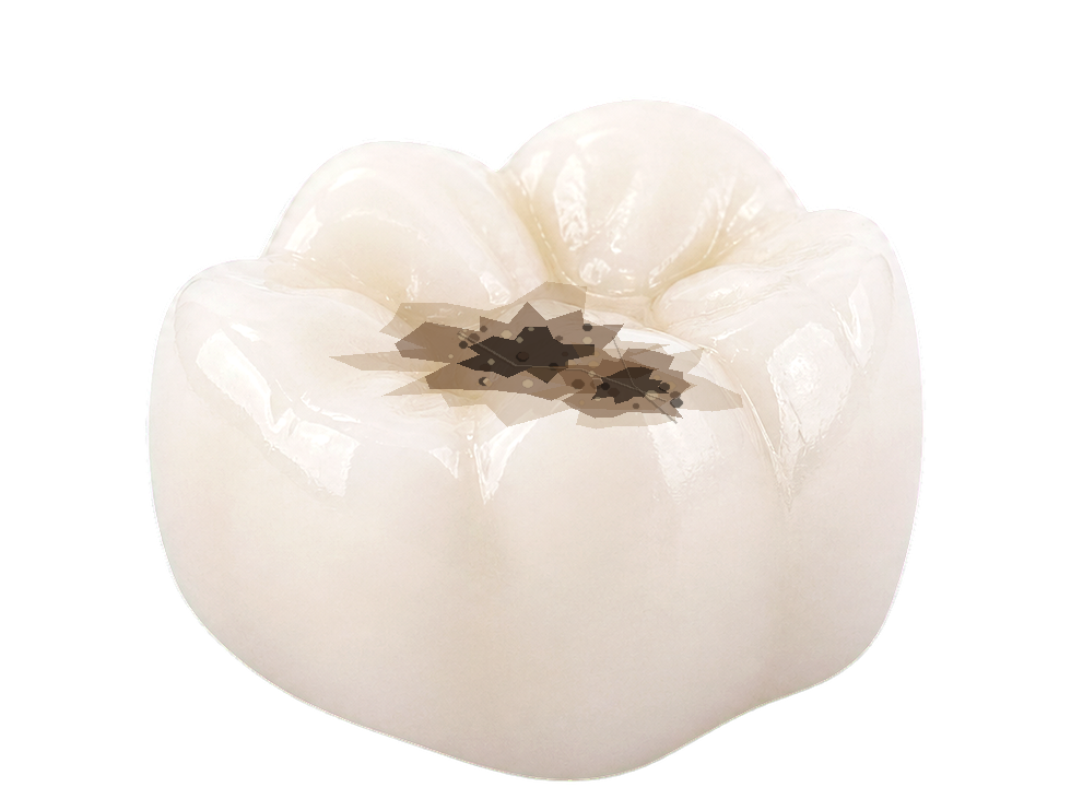 Molar with broader damage where partial coverage may support one weakened cusp.