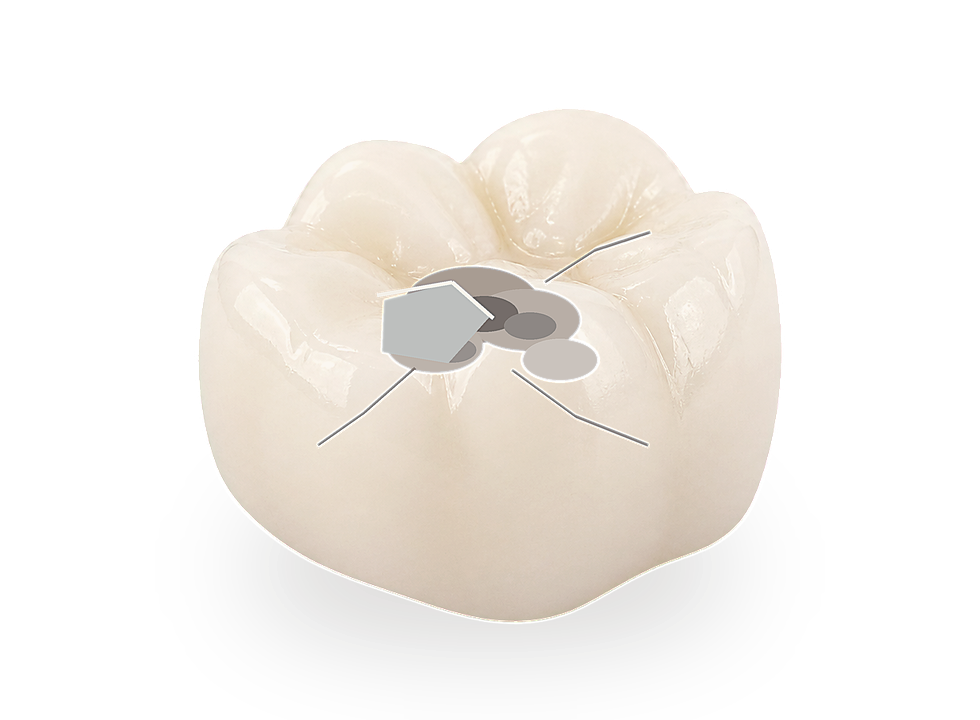 Realistic molar with decay, cracks and failing material before crown preparation.