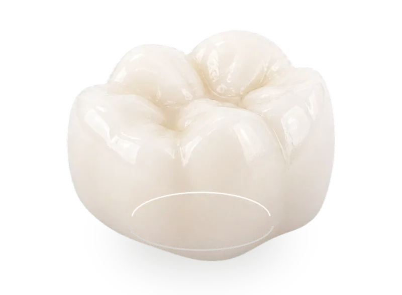 Final dental crown seated over a prepared natural tooth core.