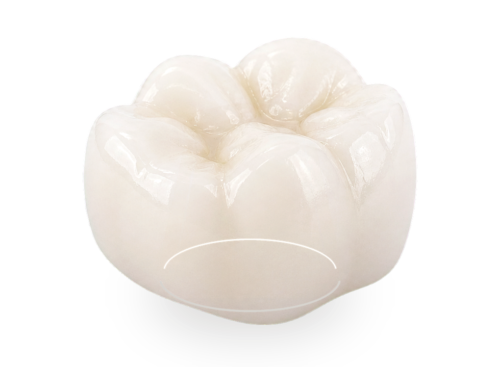 Final dental crown seated over a prepared natural tooth core.