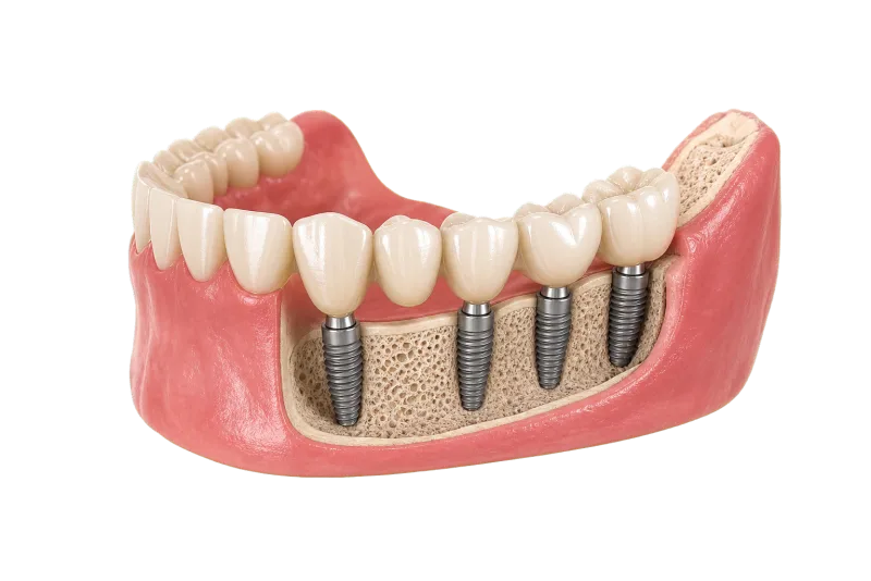 Transparent full-arch support visual for segmented implant bridge planning.