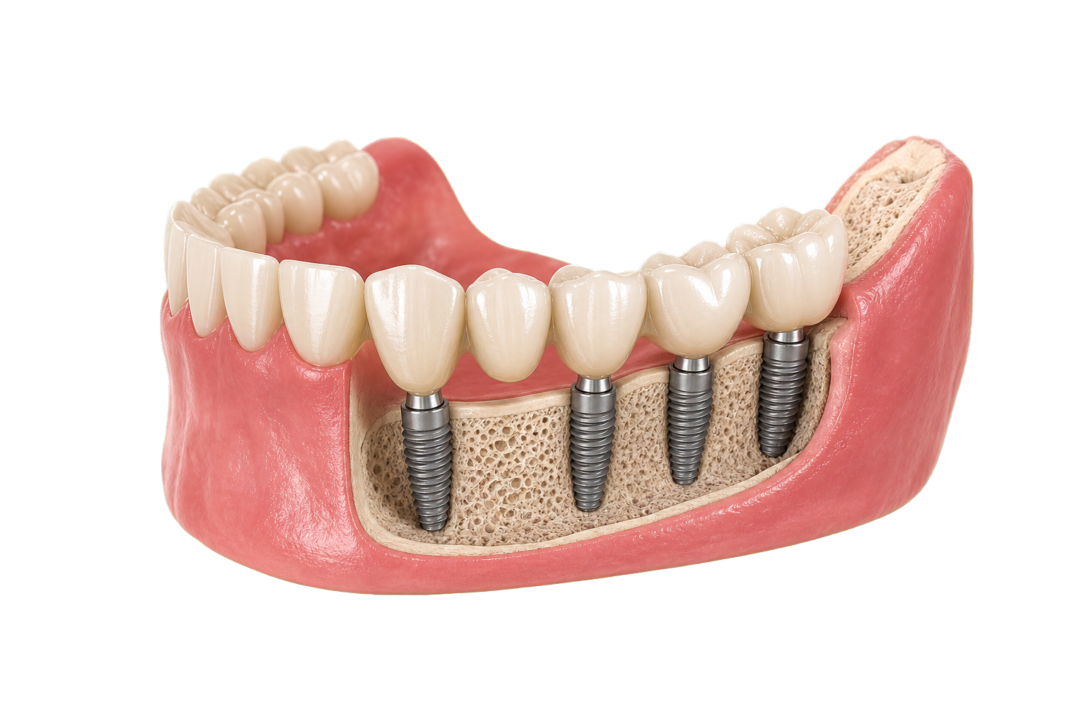 Transparent full-arch support visual for segmented implant bridge planning.