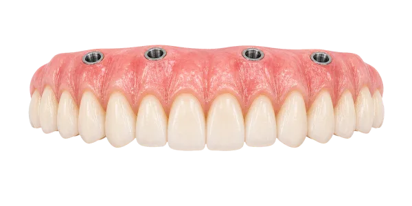 Transparent screw-retained full-arch bridge used for All On 5 by Dr Jimenez full-arch reconstruction planning.
