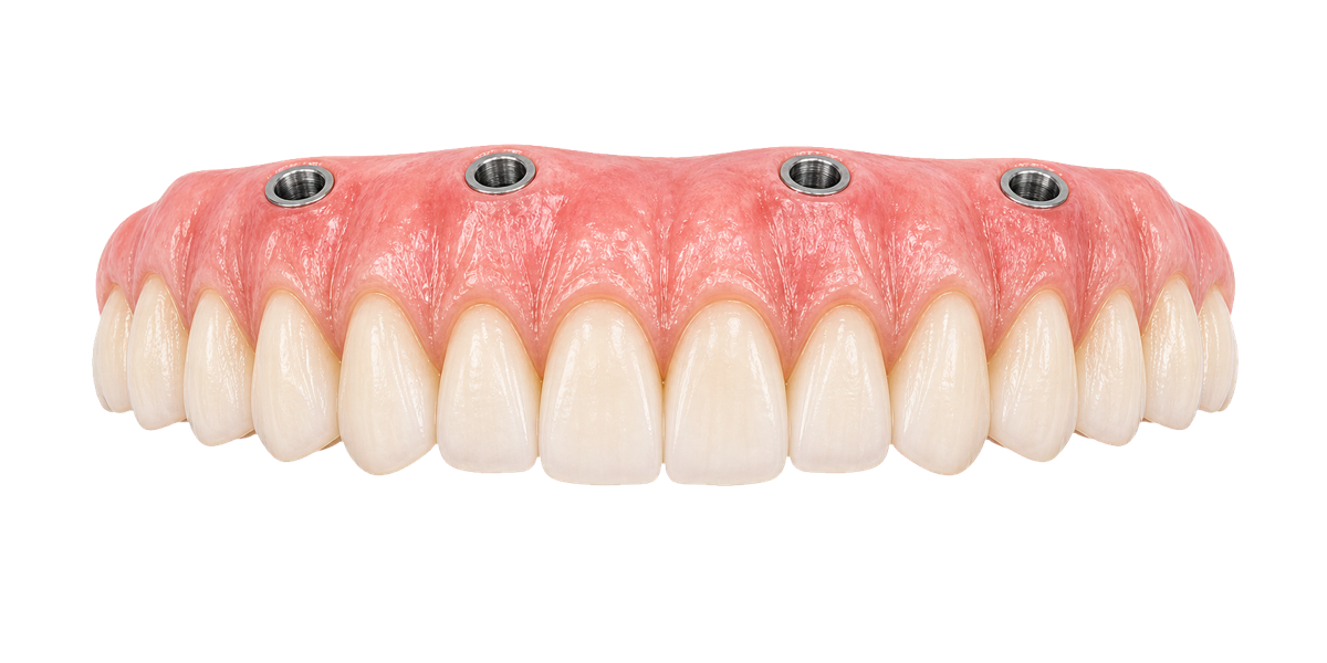 Transparent screw-retained full-arch bridge used for All On 5 by Dr Jimenez full-arch reconstruction planning.