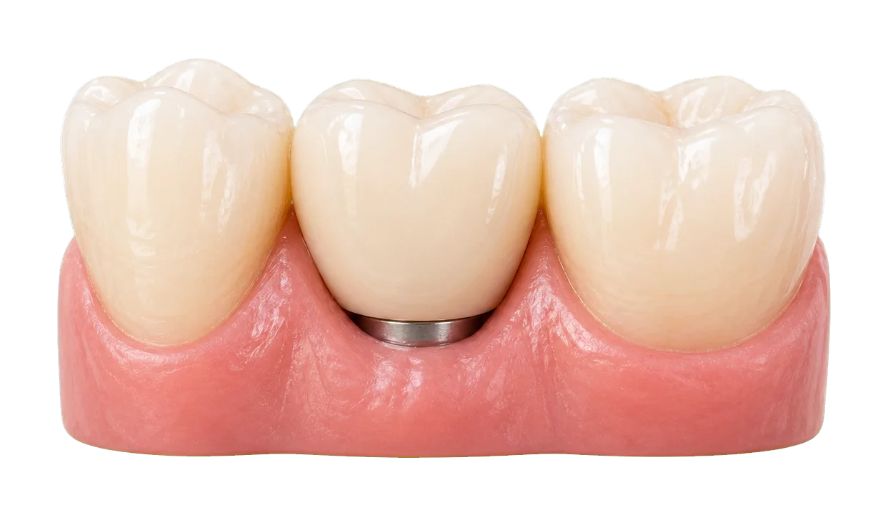 Finished single dental implant crown between neighboring teeth.