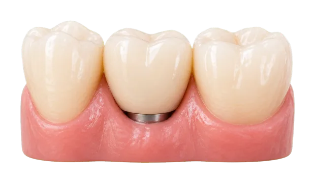 Transparent single dental implant with final crown.