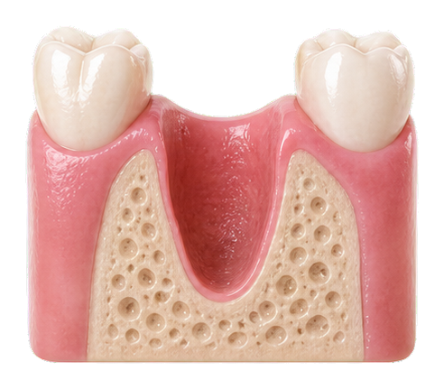 Clean socket and quiet tissue before implant planning.