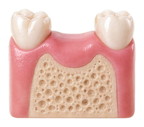 Healed gum and bone ridge shaped for implant placement.