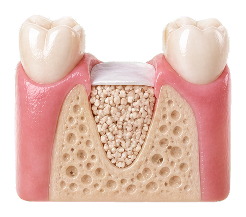 Bone graft material placed into the prepared ridge.