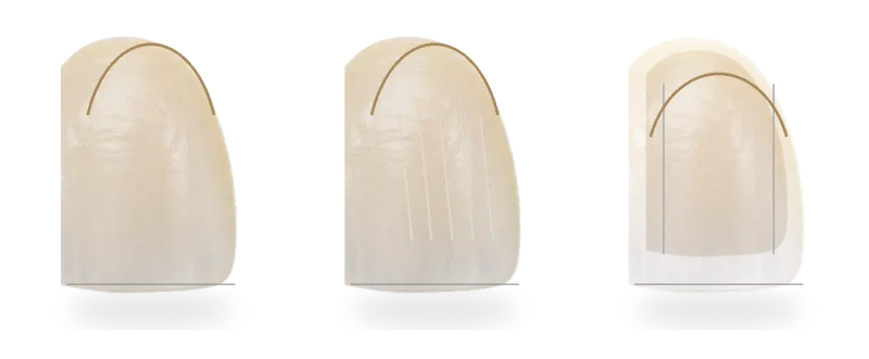 Enamel preservation guide for cosmetic planning.