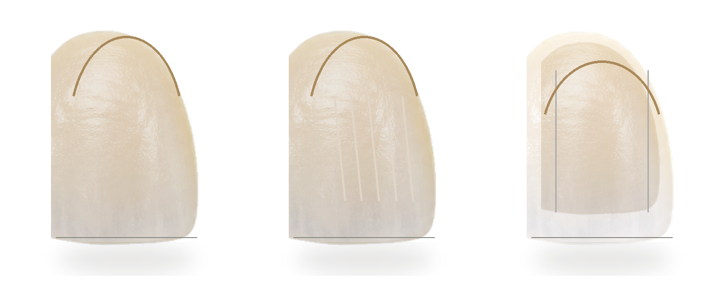 No-prep, minimal-prep and conventional veneer preparation guide on front teeth.