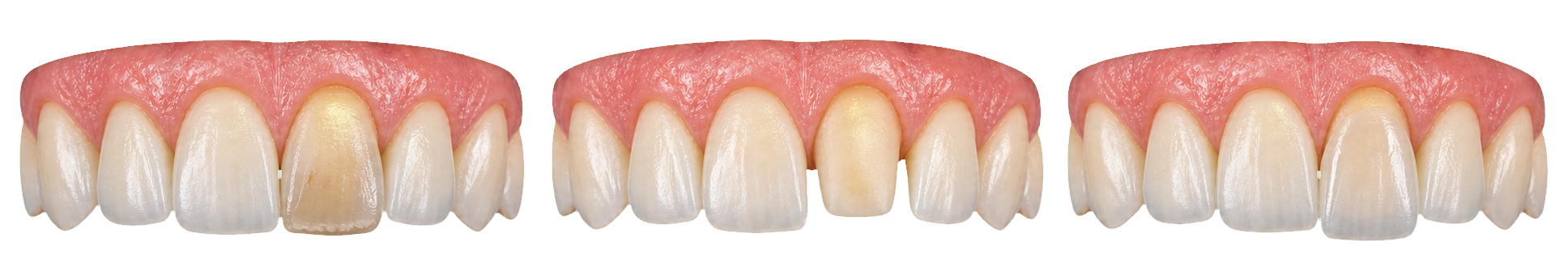 Full-arch veneer progression showing a compromised front tooth, conservative preparation and translucent veneer placement.