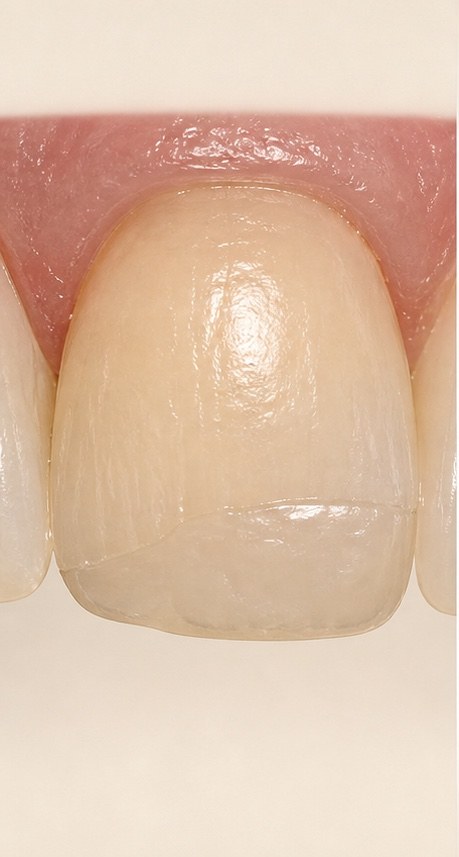 Close-up composite veneer surface with warmer blending and repairable resin texture.