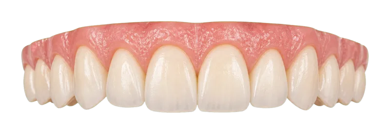 Transparent smile-zone veneer planning visual.