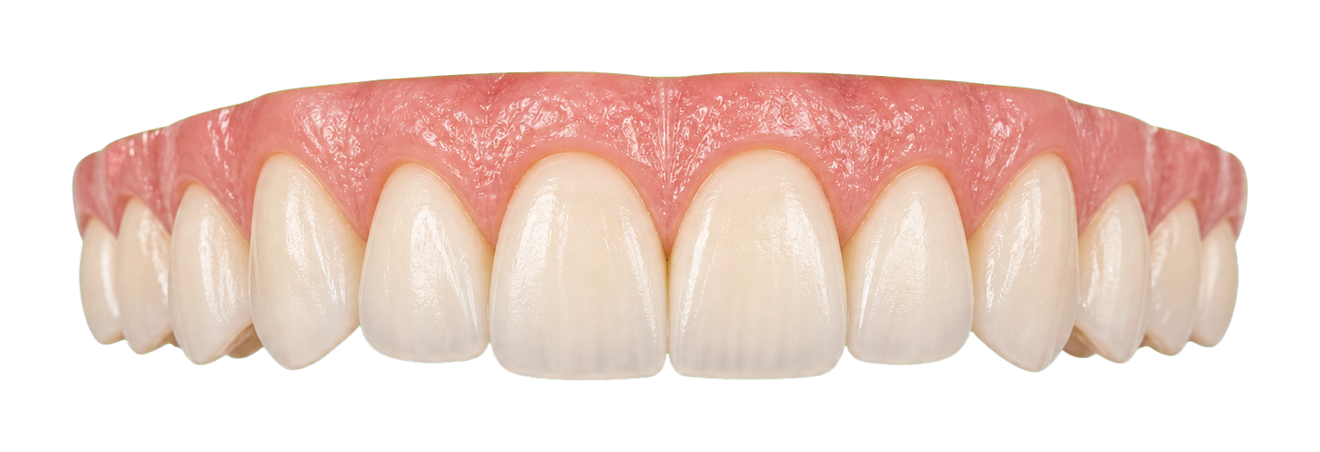 Upper front teeth used to explain visible smile-zone veneer planning.